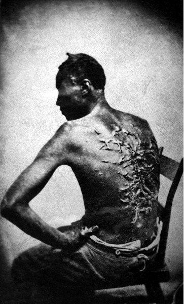 Бывший раб показывает свои шрамы от битья, штат Луизиана США, 1863 г.