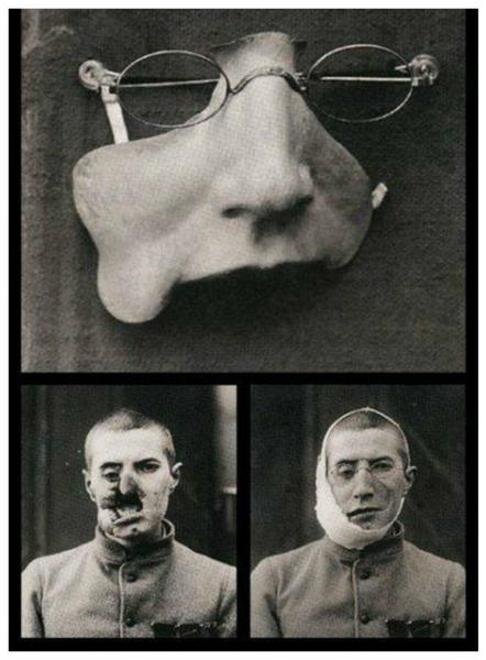 Лицевой протез для раненого солдата Первой мировой войны